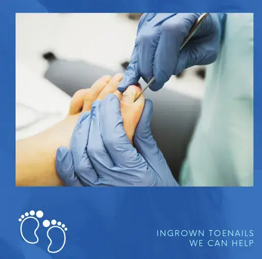 Ingrown Toenail Removal Singapore