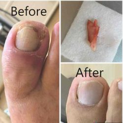 Surgery for Ingrown Toenail Singapore - First Review
