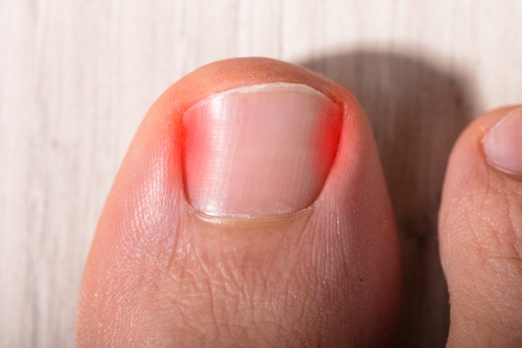 Preventing Ingrown Toenails: Tips for Proper Nail Care Preventing Ingrown Toenails: Tips for Proper Nail Care