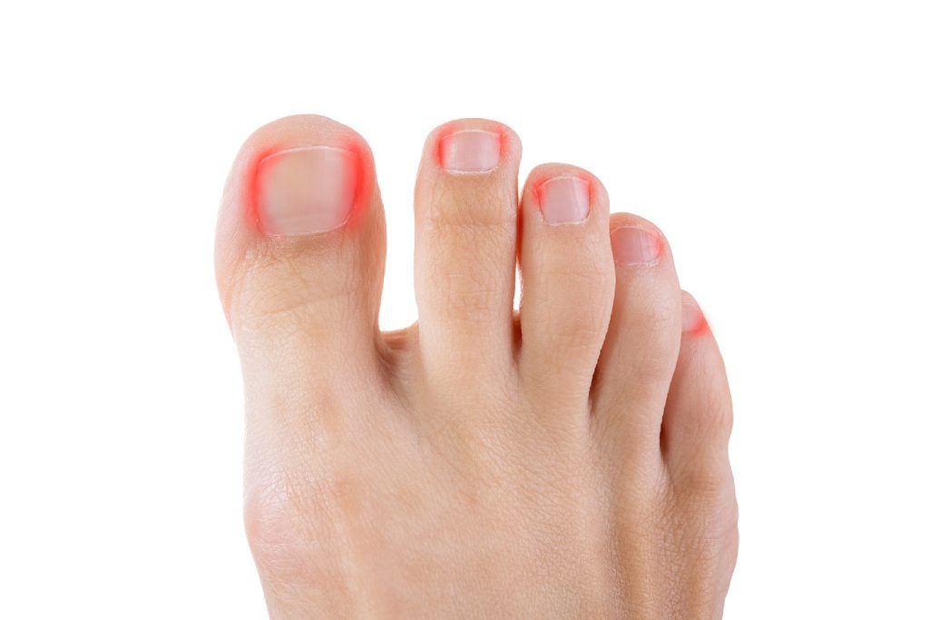 Ingrown Toenails Keep Returning? How a Podiatrist Can Help Ingrown Toenails Keep Returning? How a Podiatrist Can Help