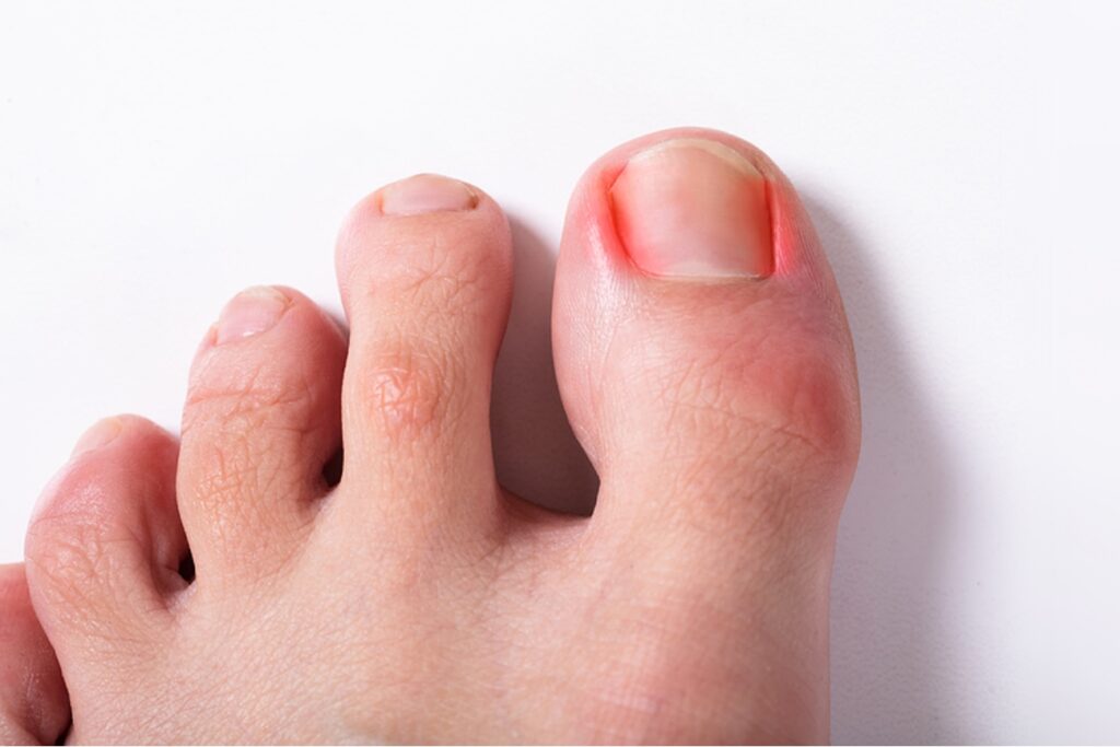 Tight Shoes Causing Ingrown Nails? Here’s What to Do