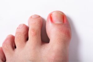 Tight Shoes Causing Ingrown Nails? Here’s What to Do