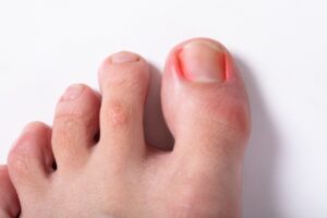 What Causes Ingrown Toenails and How to Prevent Them