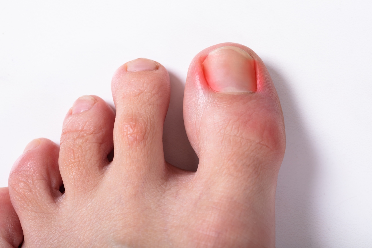 What Causes Ingrown Toenails and How to Prevent Them