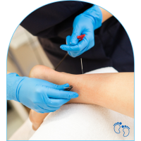 foot pain podiatry dry needling